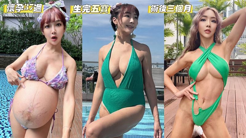 李宓術後對比照