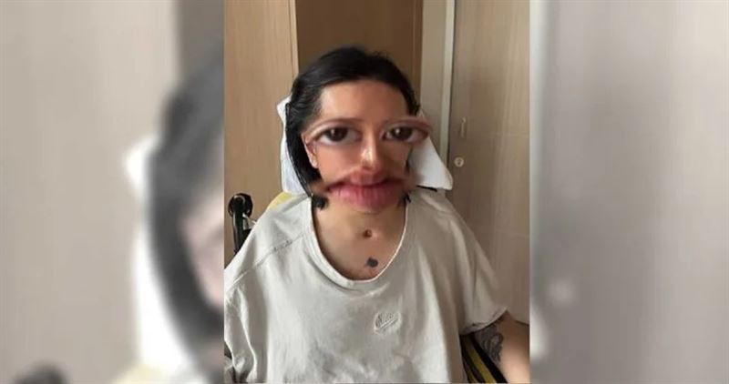 阿Mo正面照與插管傷口