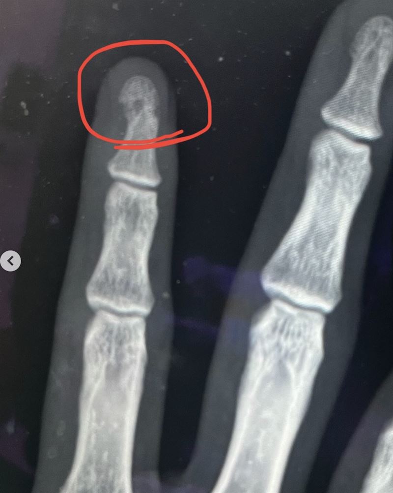 手指腫脹與X光片示意