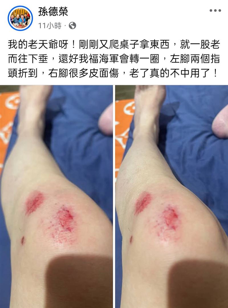孫德榮摔傷照片